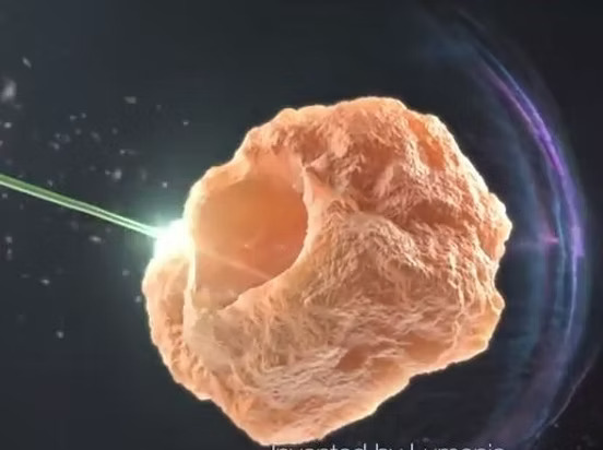Διουρηθρική Κυστεολιθοτριψία με Laser Υψηλής Ισχύος